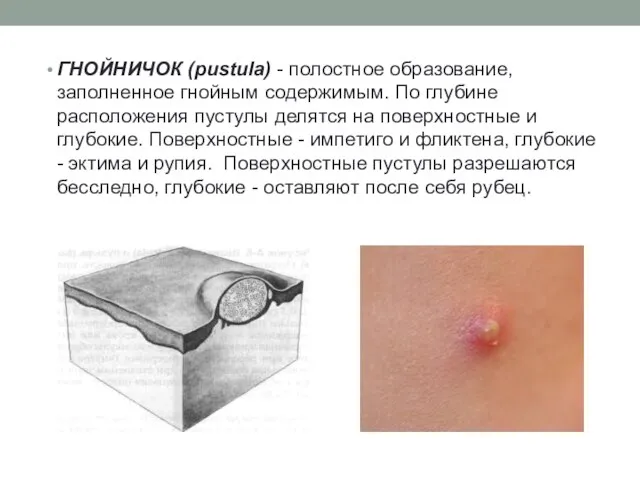 ГНОЙНИЧОК (pustula) - полостное образование, заполненное гнойным содержимым. По глубине расположения