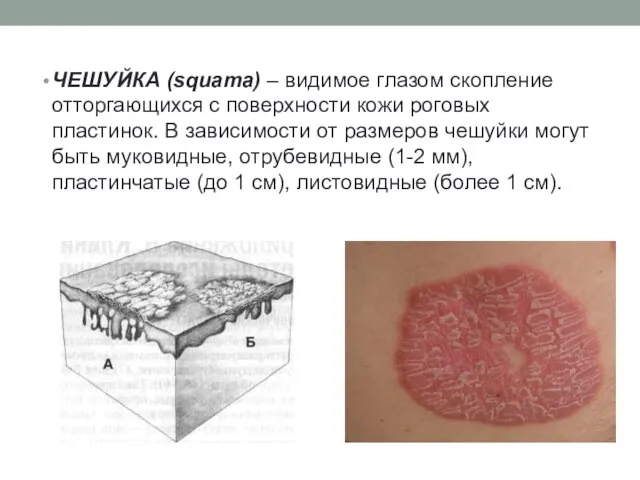 ЧЕШУЙКА (squama) – видимое глазом скопление отторгающихся с поверхности кожи роговых