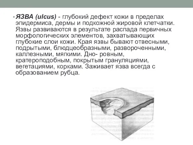 ЯЗВА (ulcus) - глубокий дефект кожи в пределах эпидермиса, дермы и