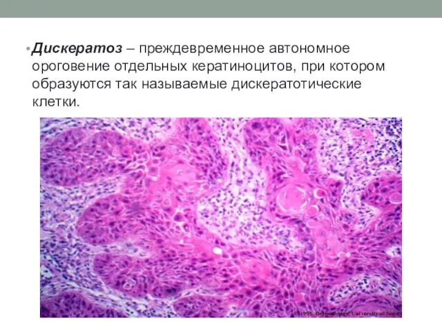 Дискератоз – преждевременное автономное ороговение отдельных кератиноцитов, при котором образуются так называемые дискератотические клетки.