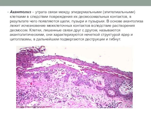 Акантолиз – утрата связи между эпидермальными (эпителиальными) клетками в следствии повреждения