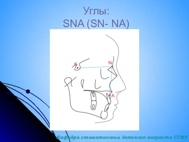 Углы: SNA (SN- NA) S N A Кафедра стоматологии детского возраста СГМУ