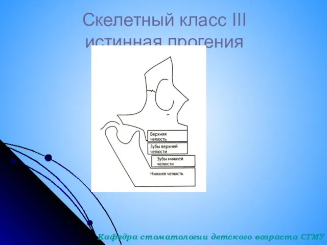 Скелетный класс III истинная прогения Кафедра стоматологии детского возраста СГМУ