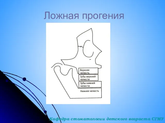 Ложная прогения Кафедра стоматологии детского возраста СГМУ