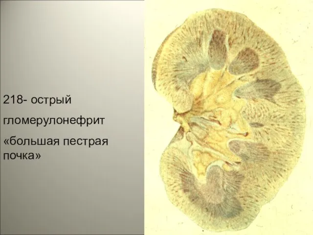 218- острый гломерулонефрит «большая пестрая почка»