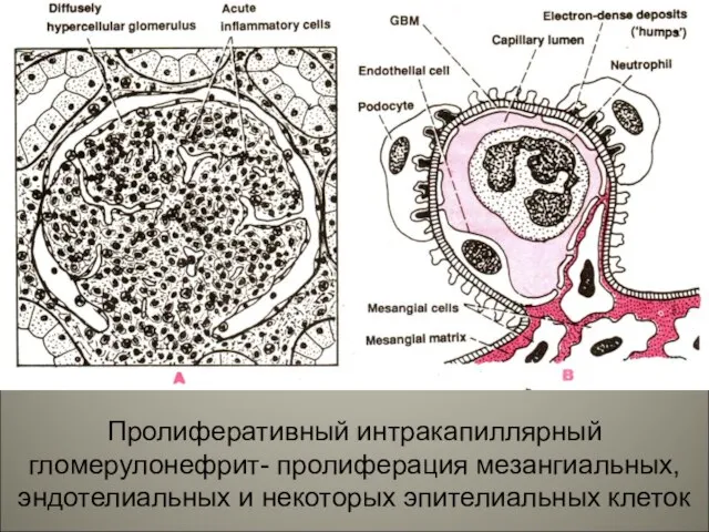 Пролиферативный интракапиллярный гломерулонефрит- пролиферация мезангиальных, эндотелиальных и некоторых эпителиальных клеток