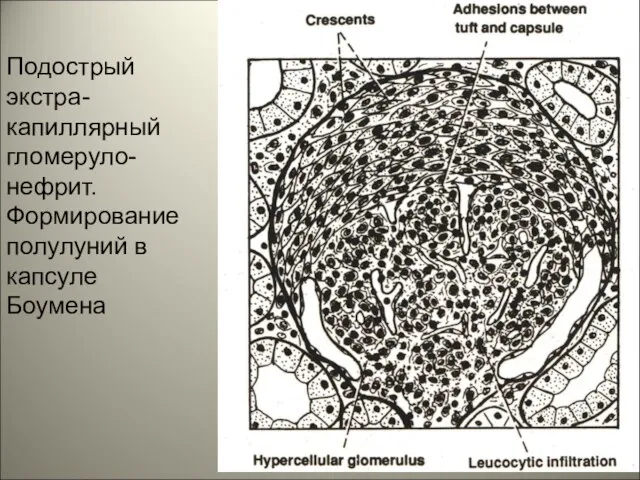 Подострый экстра-капиллярный гломеруло-нефрит. Формирование полулуний в капсуле Боумена