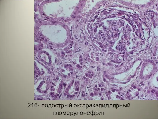 216- подострый экстракапиллярный гломерулонефрит