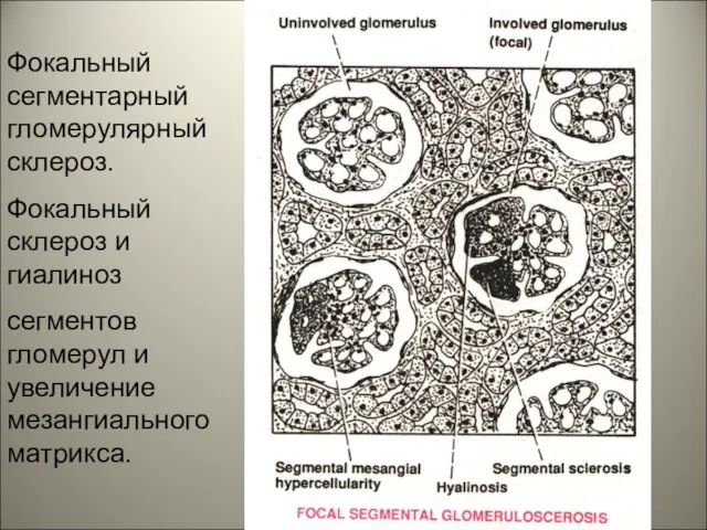 Фокальный сегментарный гломерулярный склероз. Фокальный склероз и гиалиноз сегментов гломерул и увеличение мезангиального матрикса.