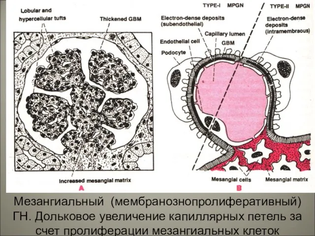 Мезангиальный (мембранознопролиферативный) ГН. Дольковое увеличение капиллярных петель за счет пролиферации мезангиальных клеток