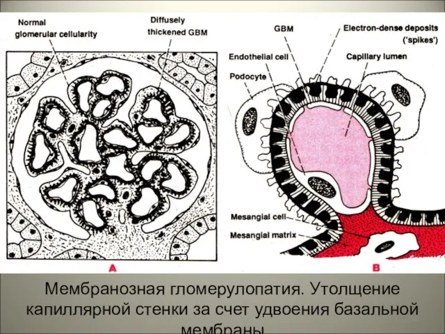 Мембранозная гломерулопатия. Утолщение капиллярной стенки за счет удвоения базальной мембраны