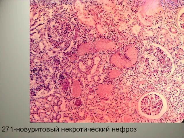 271-новуритовый некротический нефроз