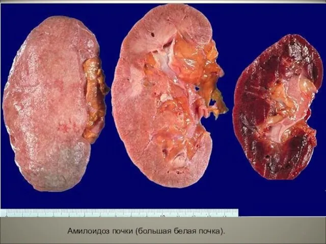 Амилоидоз почки (большая белая почка).