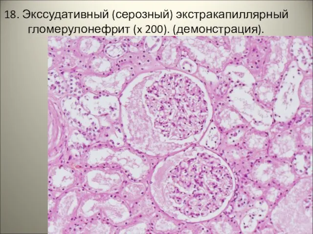 18. Экссудативный (серозный) экстракапиллярный гломерулонефрит (x 200). (демонстрация). . .