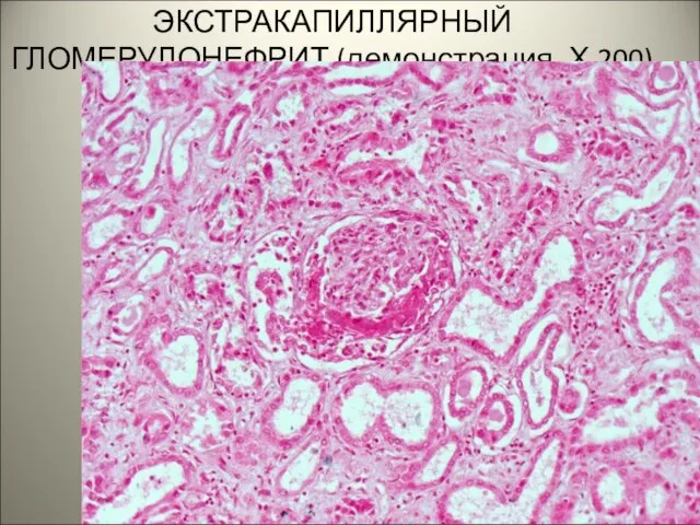 138. ПРИЛИФЕРАТИВНЫЙ ЭКСТРАКАПИЛЛЯРНЫЙ ГЛОМЕРУЛОНЕФРИТ (демонстрация, Х 200). .