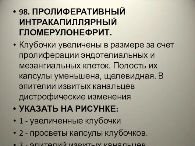 98. ПРОЛИФЕРАТИВНЫЙ ИНТРАКАПИЛЛЯРНЫЙ ГЛОМЕРУЛОНЕФРИТ. Клубочки увеличены в размере за счет пролиферации