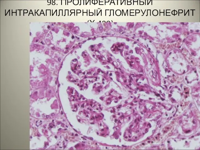 98. ПРОЛИФЕРАТИВНЫЙ ИНТРАКАПИЛЛЯРНЫЙ ГЛОМЕРУЛОНЕФРИТ (Х 400)