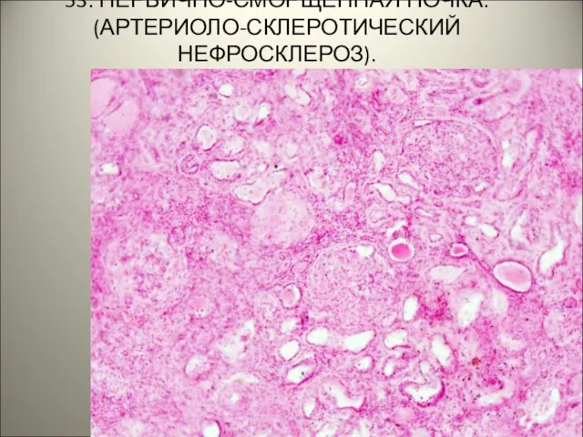 53. ПЕРВИЧНО-СМОРЩЕННАЯ ПОЧКА. (АРТЕРИОЛО-СКЛЕРОТИЧЕСКИЙ НЕФРОСКЛЕРОЗ).