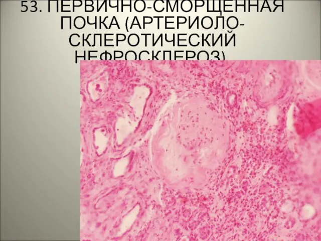 53. ПЕРВИЧНО-СМОРЩЕННАЯ ПОЧКА (АРТЕРИОЛО-СКЛЕРОТИЧЕСКИЙ НЕФРОСКЛЕРОЗ).