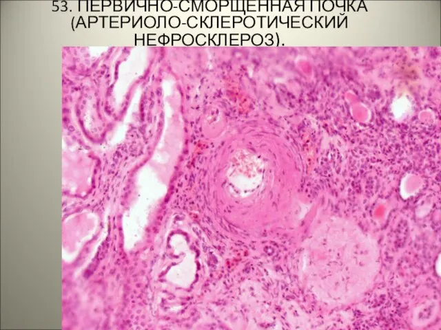 53. ПЕРВИЧНО-СМОРЩЕННАЯ ПОЧКА (АРТЕРИОЛО-СКЛЕРОТИЧЕСКИЙ НЕФРОСКЛЕРОЗ).