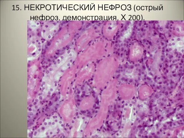 15. НЕКРОТИЧЕСКИЙ НЕФРОЗ (острый нефроз, демонстрация, Х 200).