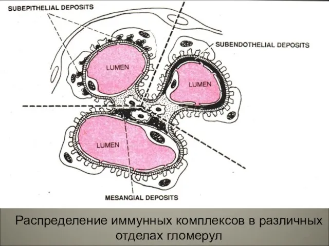 Распределение иммунных комплексов в различных отделах гломерул