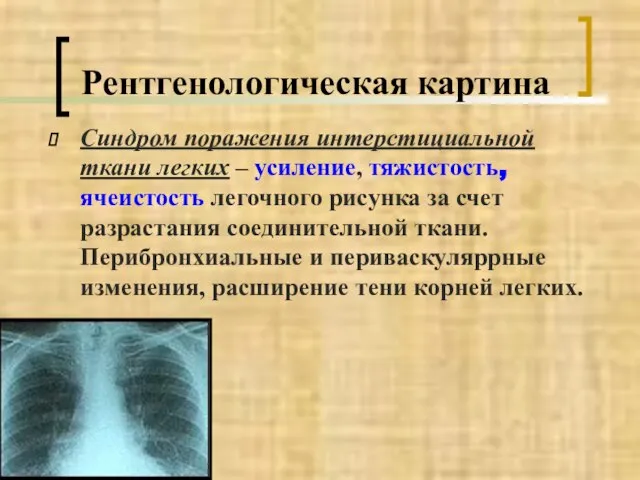 Рентгенологическая картина Синдром поражения интерстициальной ткани легких – усиление, тяжистость, ячеистость