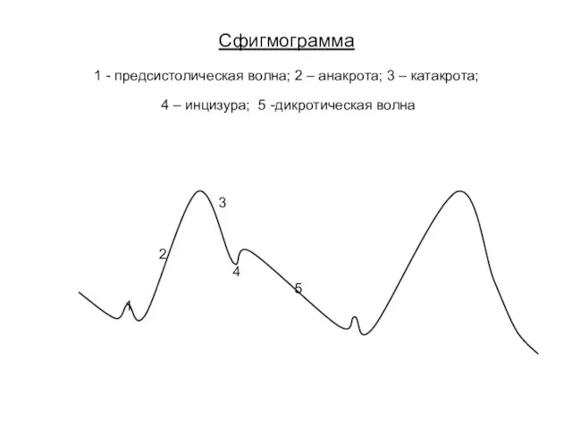 Сфигмограмма 1 - предсистолическая волна; 2 – анакрота; 3 – катакрота;