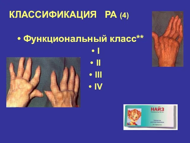 КЛАССИФИКАЦИЯ РА (4) Функциональный класс** I II III IV