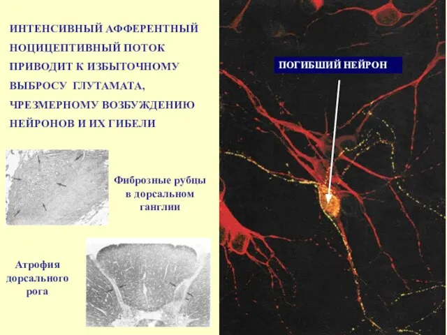 ПОГИБШИЙ НЕЙРОН ИНТЕНСИВНЫЙ АФФЕРЕНТНЫЙ НОЦИЦЕПТИВНЫЙ ПОТОК ПРИВОДИТ К ИЗБЫТОЧНОМУ ВЫБРОСУ ГЛУТАМАТА,