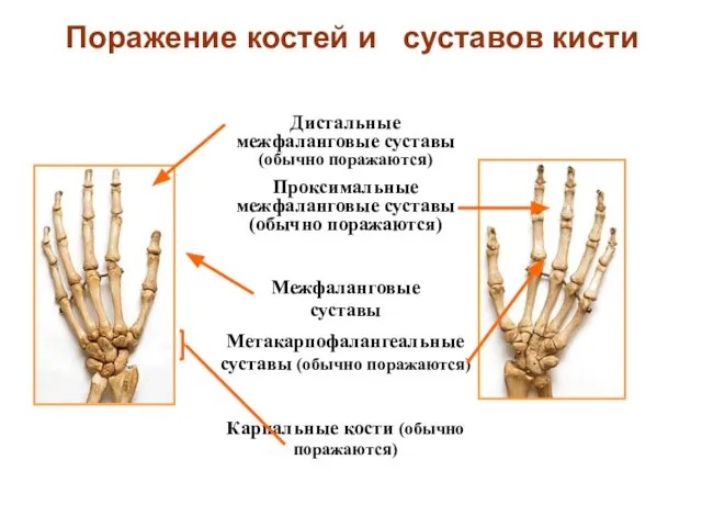 Поражение костей и суставов кисти Дистальные межфаланговые суставы (обычно поражаются) Проксимальные