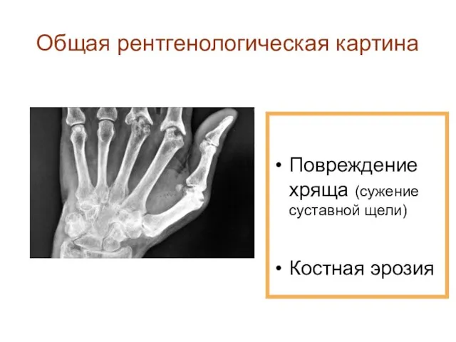 Общая рентгенологическая картина Повреждение хряща (сужение суставной щели) Костная эрозия