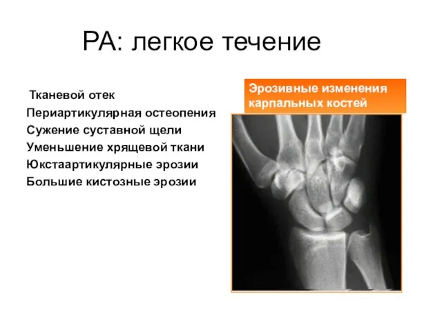 РА: легкое течение Эрозивные изменения карпальных костей Тканевой отек Периартикулярная остеопения