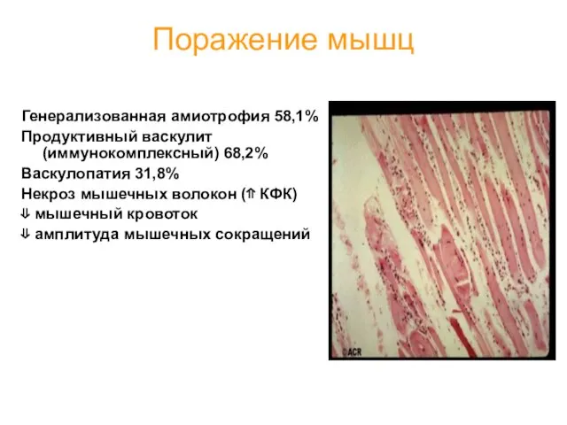 Поражение мышц Генерализованная амиотрофия 58,1% Продуктивный васкулит (иммунокомплексный) 68,2% Васкулопатия 31,8%
