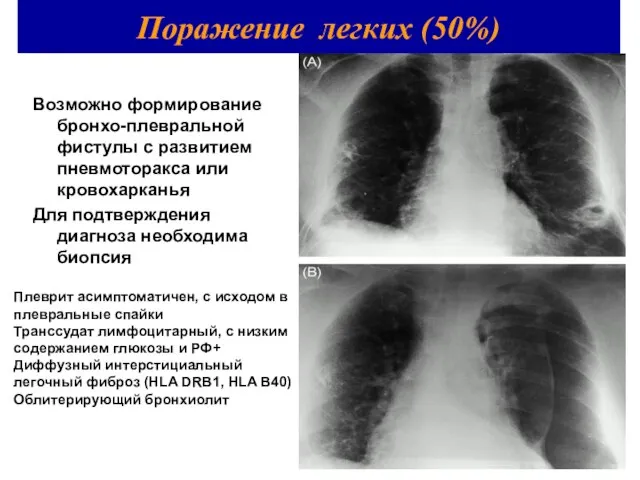 Возможно формирование бронхо-плевральной фистулы с развитием пневмоторакса или кровохарканья Для подтверждения