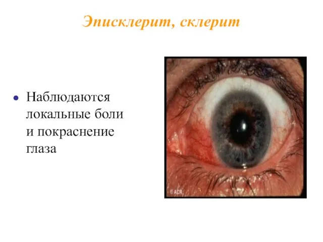 Эписклерит, склерит Наблюдаются локальные боли и покраснение глаза