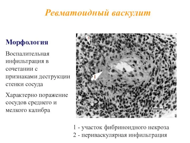 Ревматоидный васкулит 1 2 Морфология Воспалительная инфильтрация в сочетании с признаками