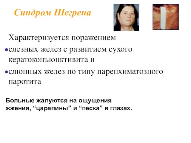 Синдром Шегрена Характеризуется поражением слезных желез с развитием сухого кератоконъюнктивита и