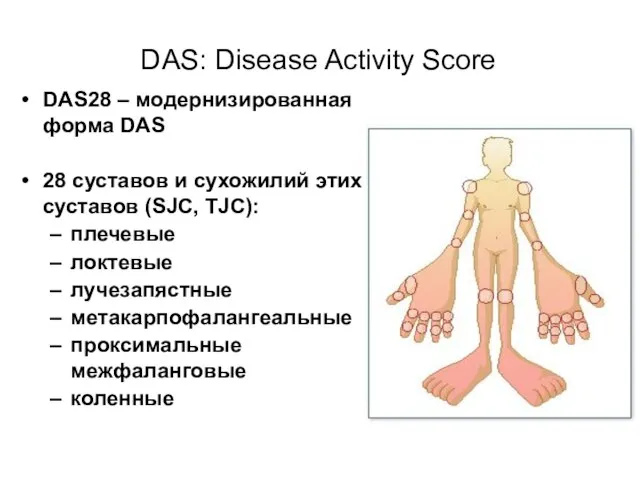 DAS28 – модернизированная форма DAS 28 суставов и сухожилий этих суставов