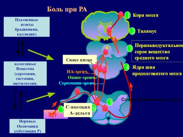 Спино-таламический путь Боль при РА Плазменные агенты брадикинин,каллидин) Нервные Окончания (субстанция