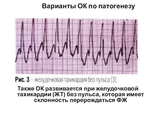 Также ОК развивается при желудочковой тахикардии (ЖТ) без пульса, которая имеет