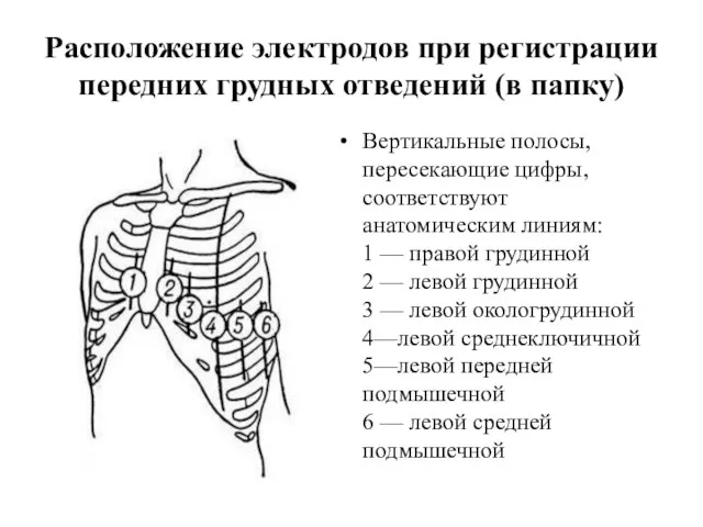 Расположение электродов при регистрации передних грудных отведений (в папку) Вертикальные полосы,