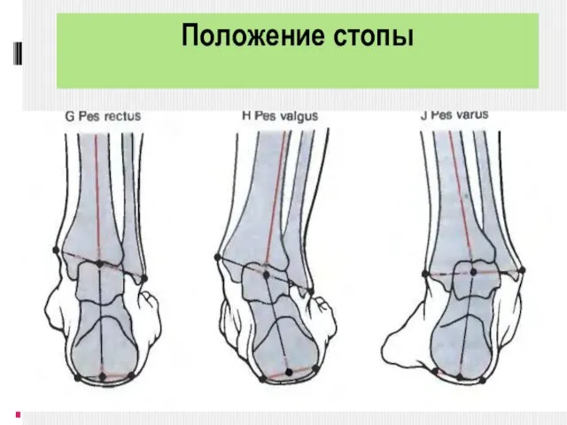 Положение стопы