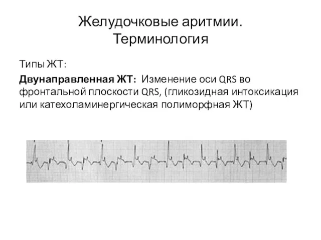 Желудочковые аритмии. Терминология Типы ЖТ: Двунаправленная ЖТ: Изменение оси QRS во