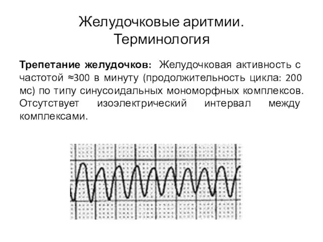 Желудочковые аритмии. Терминология Трепетание желудочков: Желудочковая активность с частотой ≈300 в