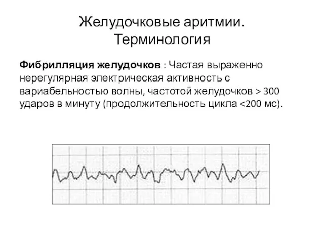 Желудочковые аритмии. Терминология Фибрилляция желудочков : Частая выраженно нерегулярная электрическая активность