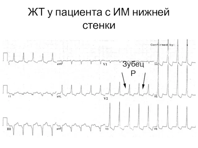 ЖТ у пациента с ИМ нижней стенки Зубец Р