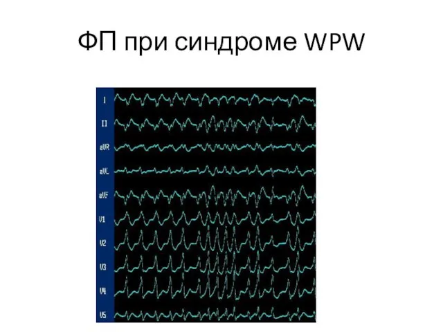 ФП при синдроме WPW