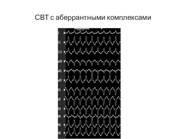 СВТ с аберрантными комплексами