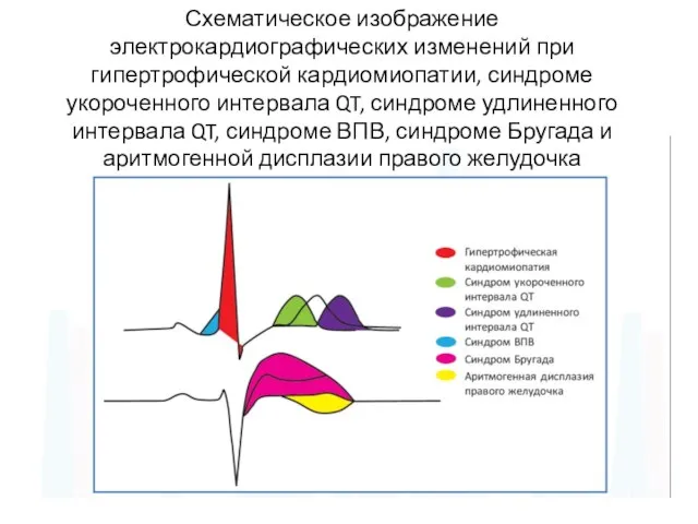 Схематическое изображение электрокардиографических изменений при гипертрофической кардиомиопатии, синдроме укороченного интервала QT,